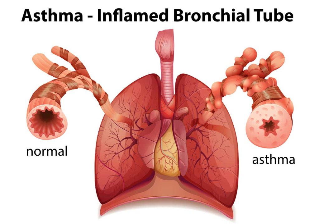 Helping You Cope With The Difficulties Of Asthma